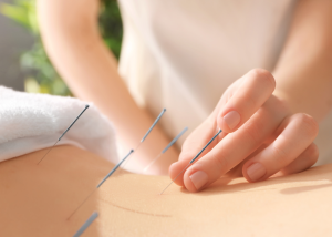acupuncture for stress