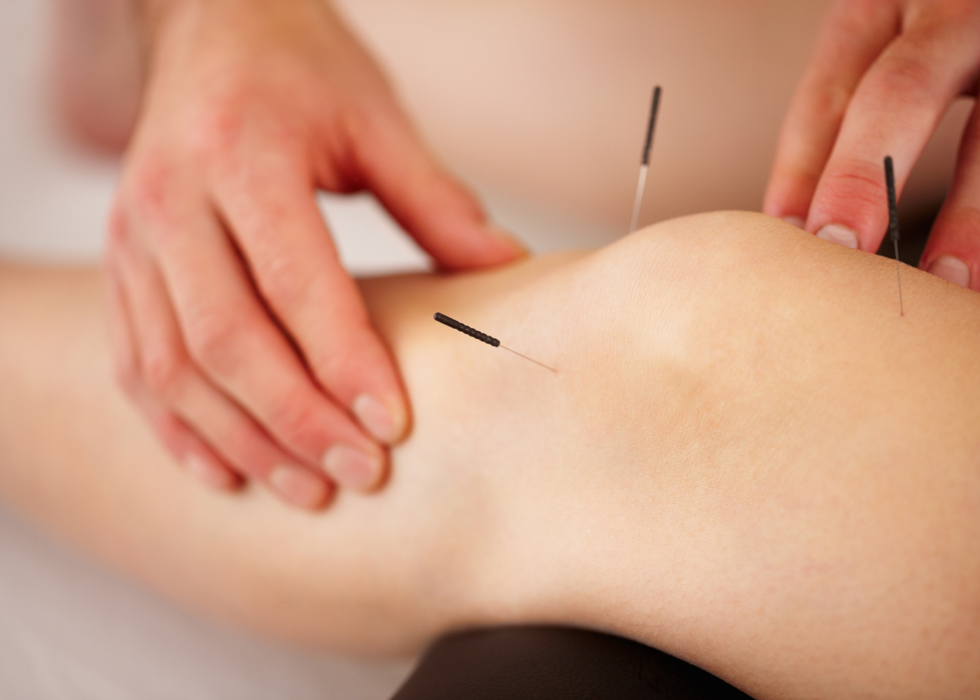 acupuncture for pain relief 